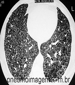 FA�A O DOWNLOAD SOBRE AS ORIENTA��ES DA ATS AO PACIENTE COM FIBROSE PULMONAR.